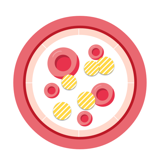 Dyslipidämie: Blut, das einen veränderten Anteil an LDL mit Cholesterin und Triglyceriden enthält